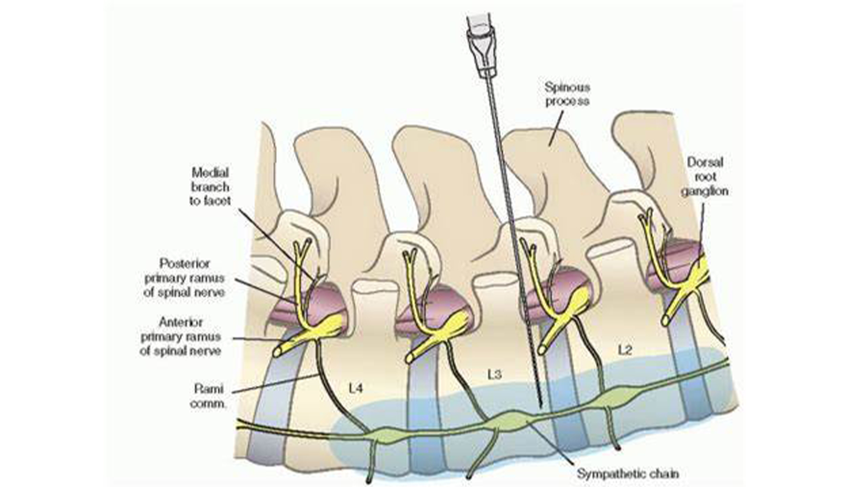 Lumbar sympathetic plexus block
