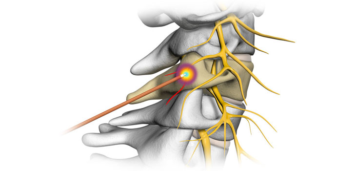 Facet joint injections and Medial branch RF ablation