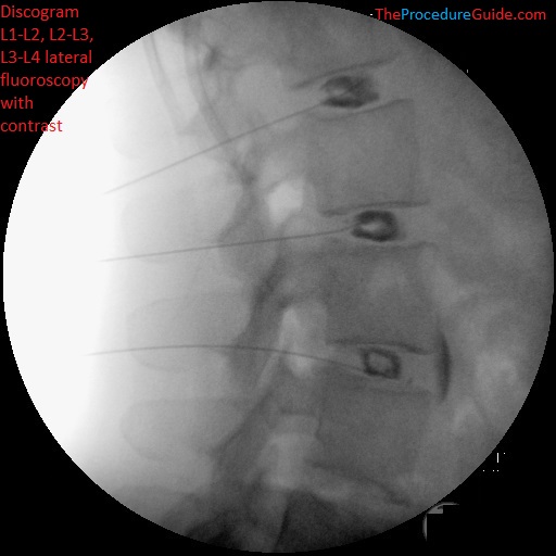 Occipital nerve block