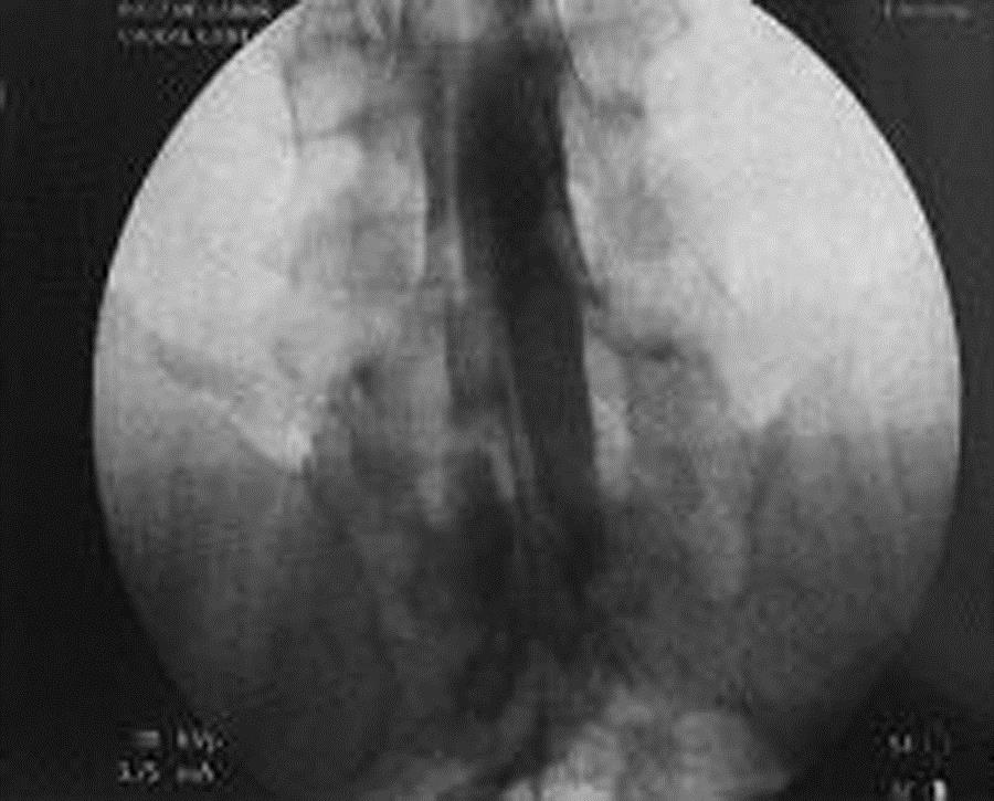 Percutaneous Adhesiolysis or Caudal neuroplasty