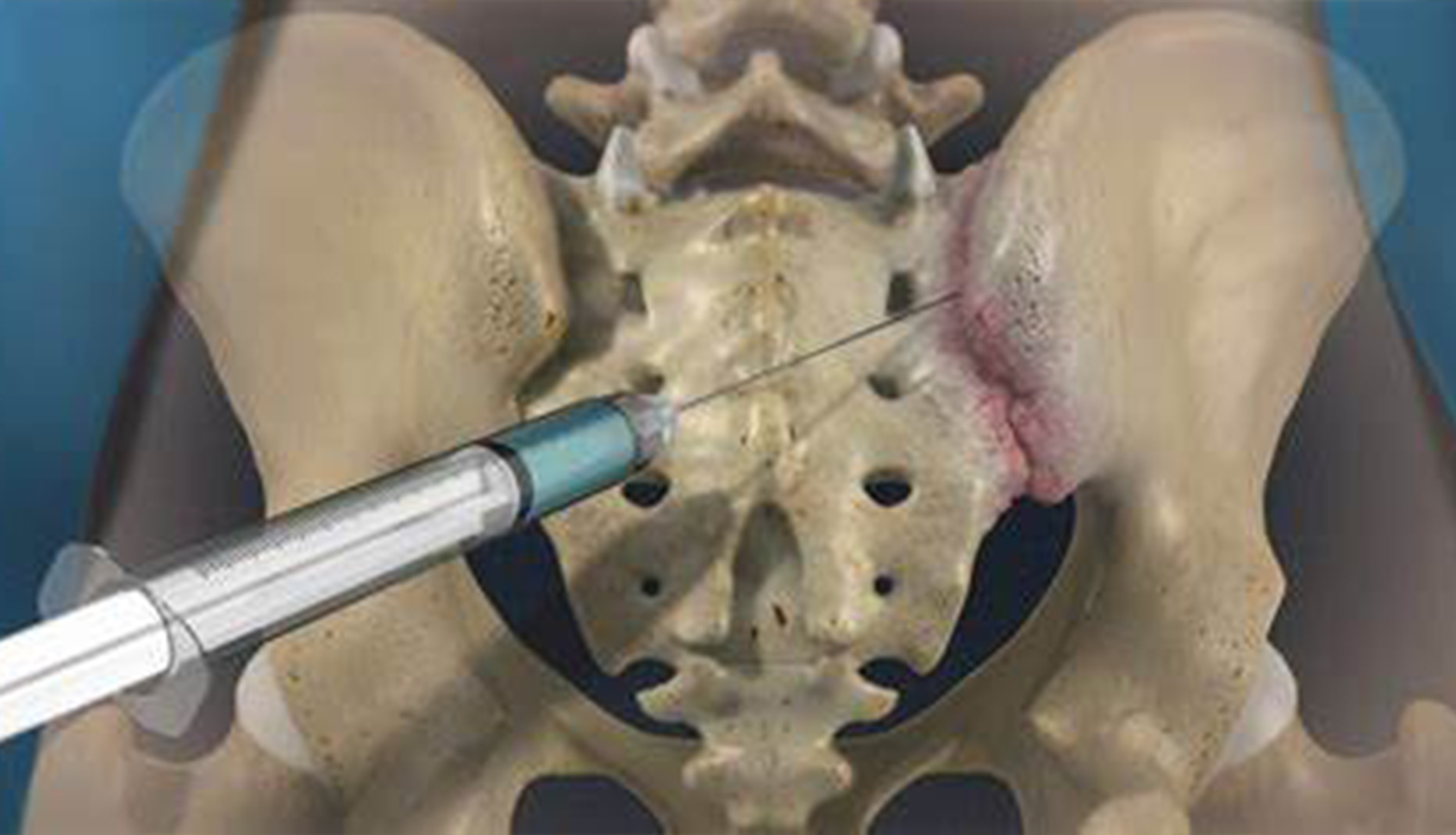 Sacroiliac joint injection