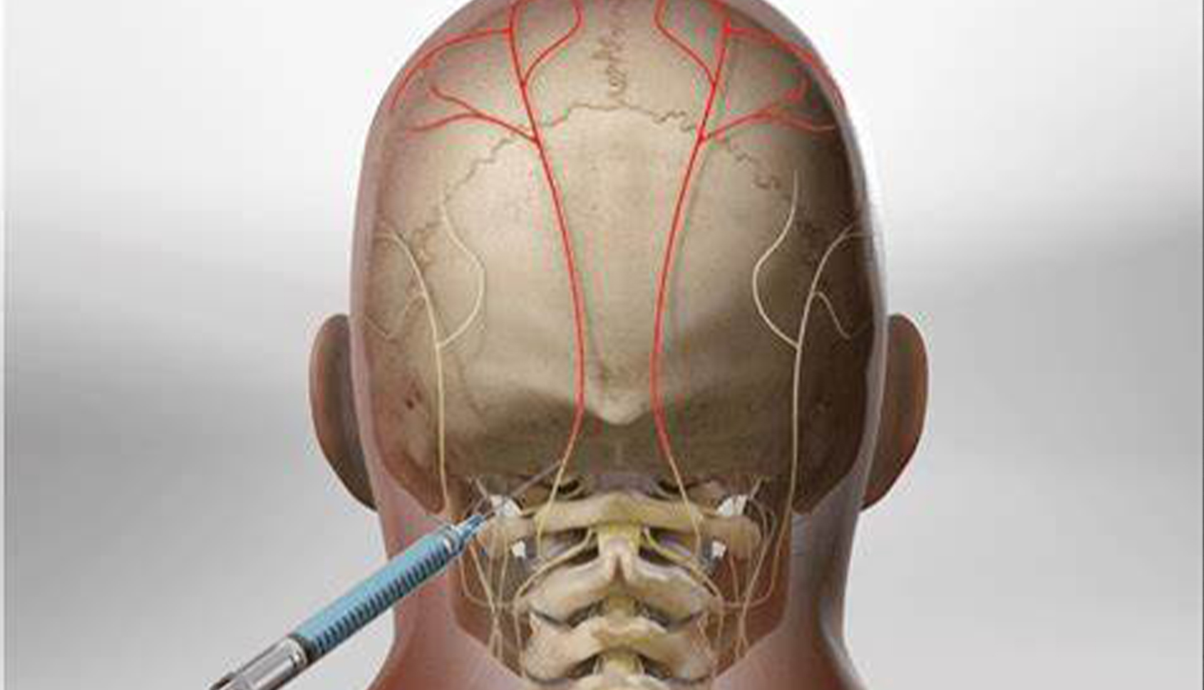 Occipital nerve block